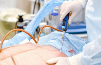 Liposuctie